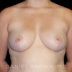 Breast Reduction Before & After Patient #9774