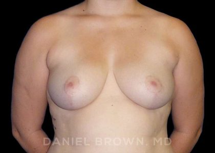 Breast Reduction Before & After Patient #9774