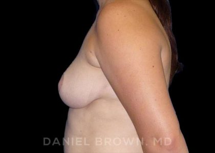 Breast Reduction Before & After Patient #9774