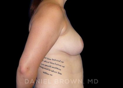 Breast Reduction Before & After Patient #9774