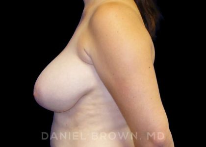 Breast Reduction Before & After Patient #9774