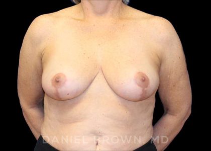 Breast Reduction Before & After Patient #9781