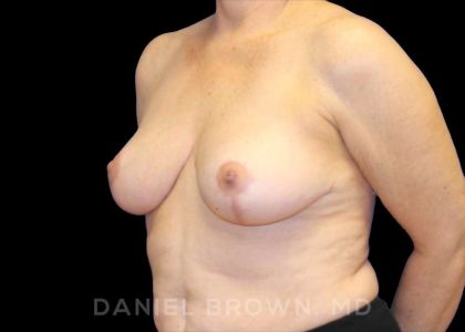 Breast Reduction Before & After Patient #9781