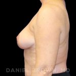 Breast Reduction Before & After Patient #9781