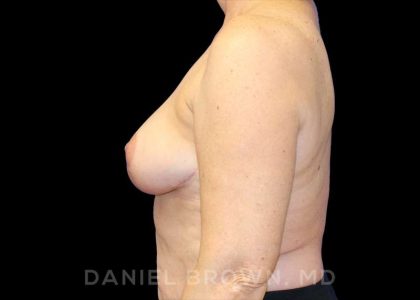 Breast Reduction Before & After Patient #9781
