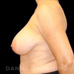 Breast Reduction Before & After Patient #9781