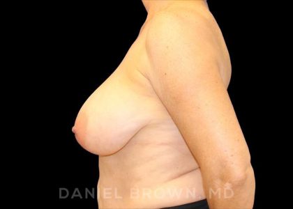 Breast Reduction Before & After Patient #9781