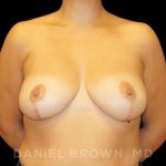 Breast Reduction Before & After Patient #9792