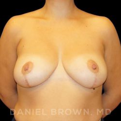 Breast Reduction Before & After Patient #9792