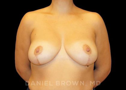 Breast Reduction Before & After Patient #9792