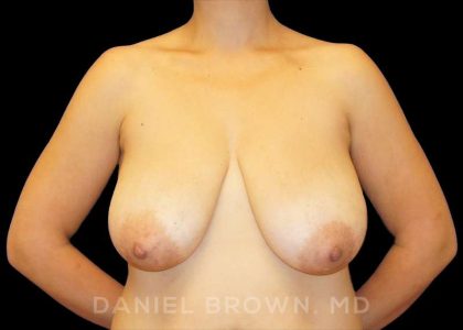 Breast Reduction Before & After Patient #9792