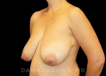 Breast Reduction Before & After Patient #9792