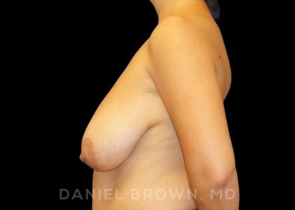 Breast Reduction Before & After Patient #9792