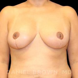 Breast Reduction Before & After Patient #9803