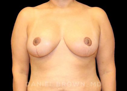 Breast Reduction Before & After Patient #9803