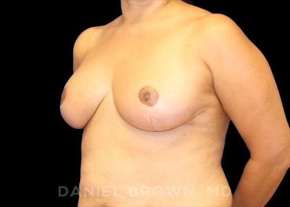 Breast Reduction Before & After Patient #9803