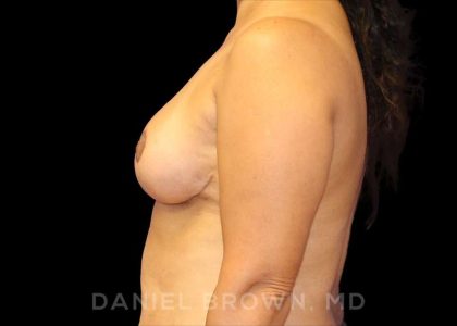 Breast Reduction Before & After Patient #9803