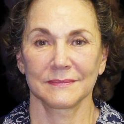 Facelift Before & After Patient #9920
