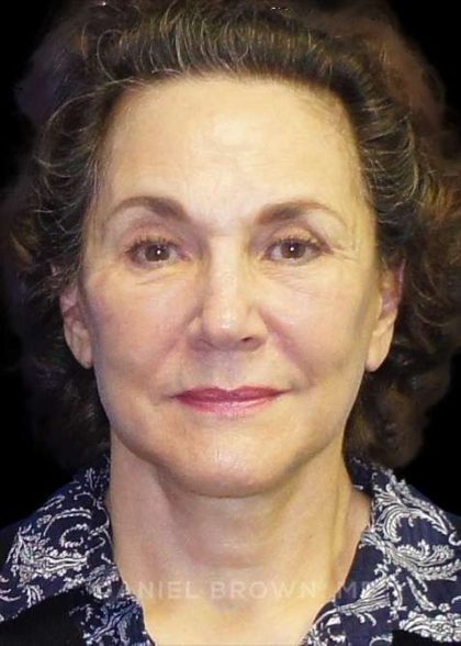 Facelift Before & After Patient #9920