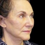 Facelift Before & After Patient #9920