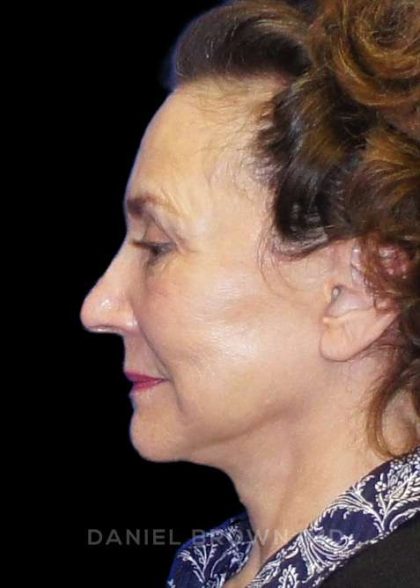 Facelift Before & After Patient #9920