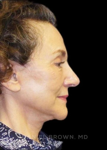 Facelift Before & After Patient #9920
