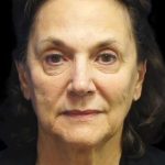 Facelift Before & After Patient #9920
