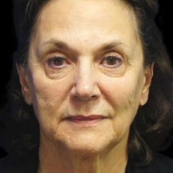 Facelift Before & After Patient #9920