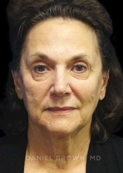 Facelift Before & After Patient #9920
