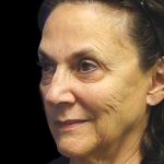 Facelift Before & After Patient #9920