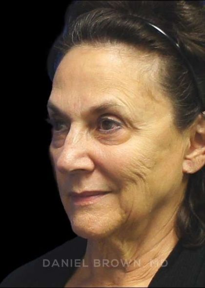 Facelift Before & After Patient #9920