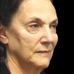 Facelift Before & After Patient #9920