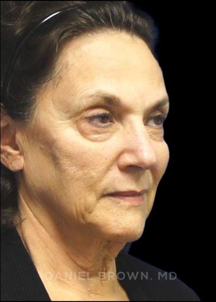 Facelift Before & After Patient #9920
