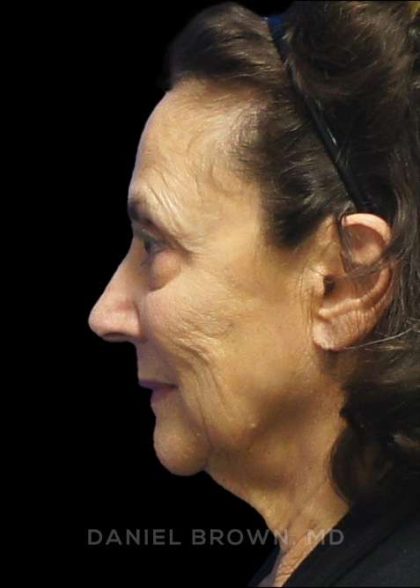 Facelift Before & After Patient #9920