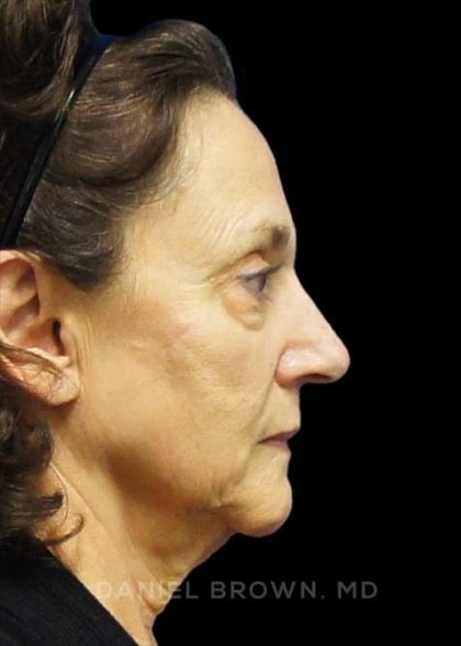 Facelift Before & After Patient #9920