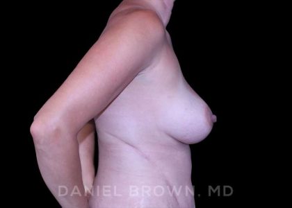 Fat Transfer Before & After Patient #9931