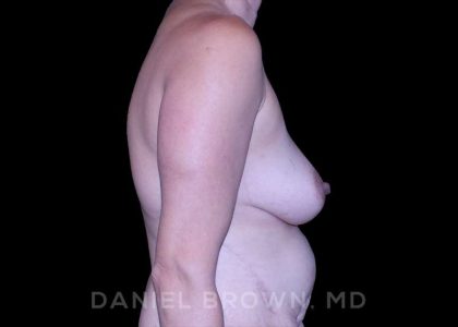 Fat Transfer Before & After Patient #9931
