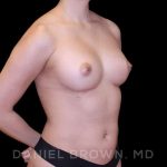 Fat Transfer Before & After Patient #9942