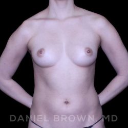 Fat Transfer Before & After Patient #9942
