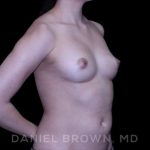 Fat Transfer Before & After Patient #9942