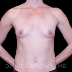 Fat Transfer Before & After Patient #9953