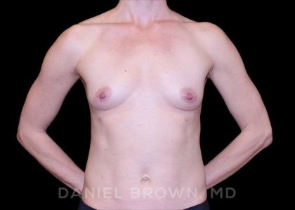 Fat Transfer Before & After Patient #9953