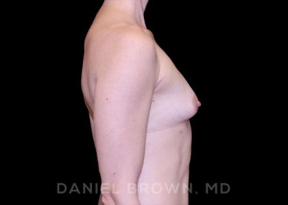 Fat Transfer Before & After Patient #9953