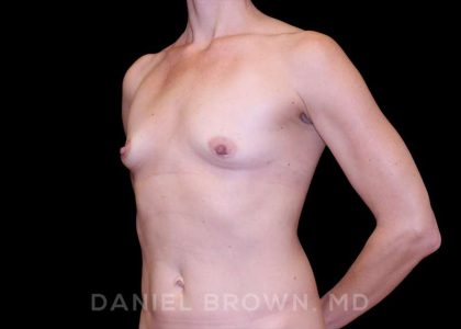 Fat Transfer Before & After Patient #9953