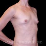 Fat Transfer Before & After Patient #9953
