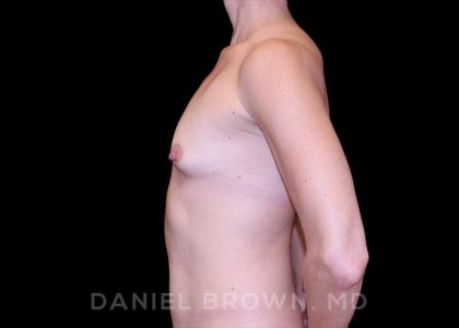 Fat Transfer Before & After Patient #9953