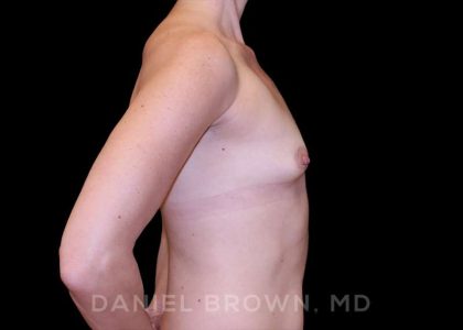 Fat Transfer Before & After Patient #9953