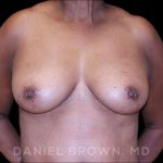 Fat Transfer Before & After Patient #9964