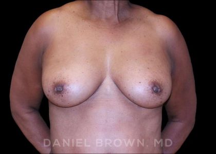 Fat Transfer Before & After Patient #9964