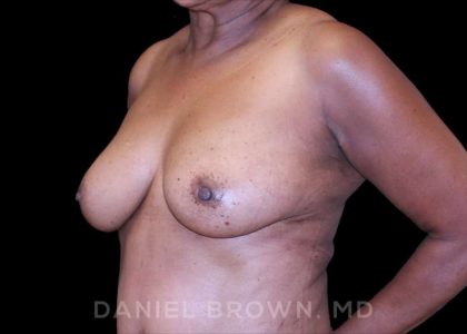 Fat Transfer Before & After Patient #9964